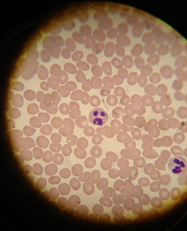 A microscopic view of mammal blood.  This leukocyte looks unhappy.
